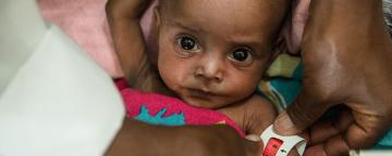 A baby is checked for malnutrition